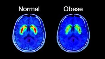 비만과 뇌의 변화와의 관계, 출처 NIH