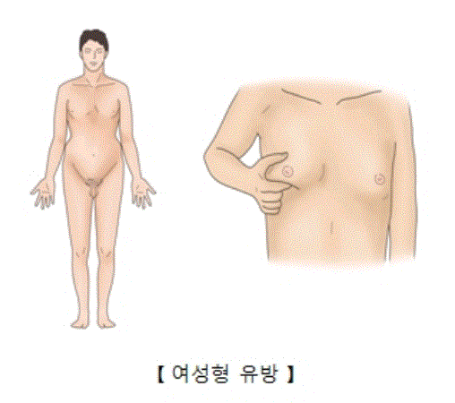 여성형 유방. 출처: 서울아산병원