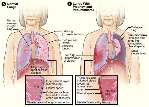 정상적인 폐와 기흉을 가진 폐의 차이. 출처: Wikimedia Commons