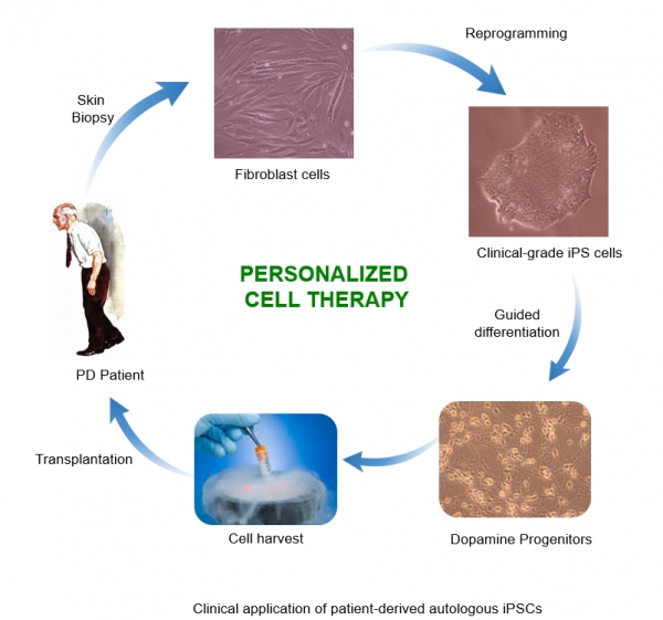 맞춤형 줄기세포를 이용한 파킨슨병 치료법 모식도. 출처: KAIST