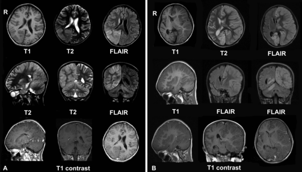 라르무센 뇌염 환자 MRI 사진. 출처: Wikimedia Commons